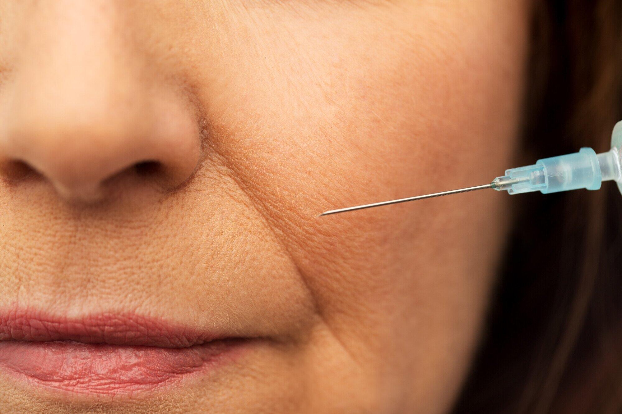 Botox myths