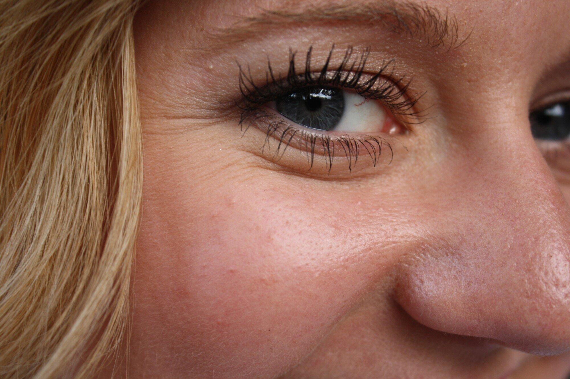 does microneedling hurt